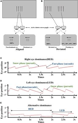 A Dichoptic Optokinetic Nystagmus Paradigm for Interocular Suppression Quantification in Intermittent Exotropia